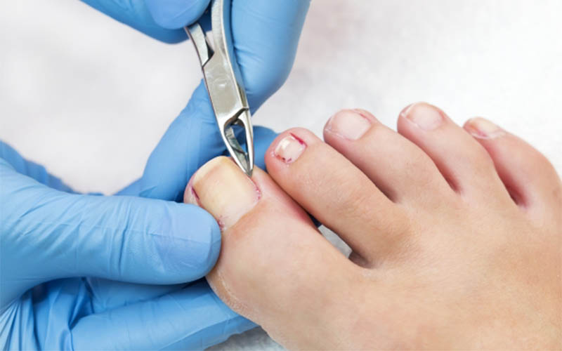 Nail Care Performed by Podiatrist