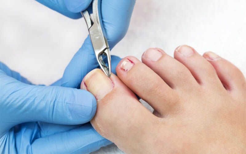 Nail reconstruction — Pulse Podiatry%