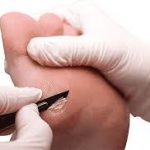 Podiatrist Skin Debridement