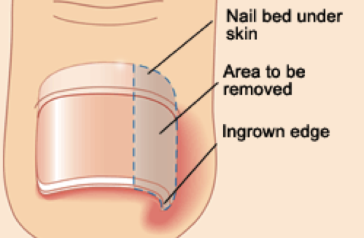 Podiatrist Ingrown Toenail