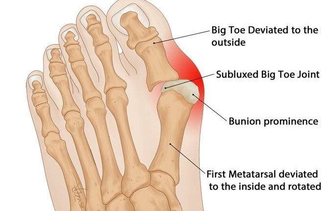 Bunion Explained