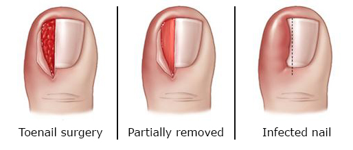 Ingrown Toenail Surgery Hobart