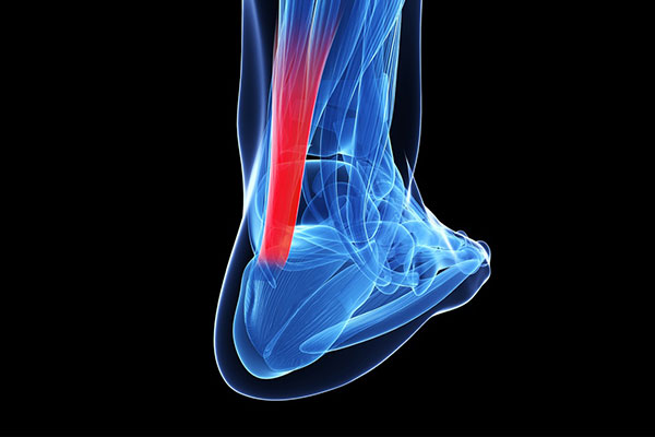 Achilles Tendon Injury